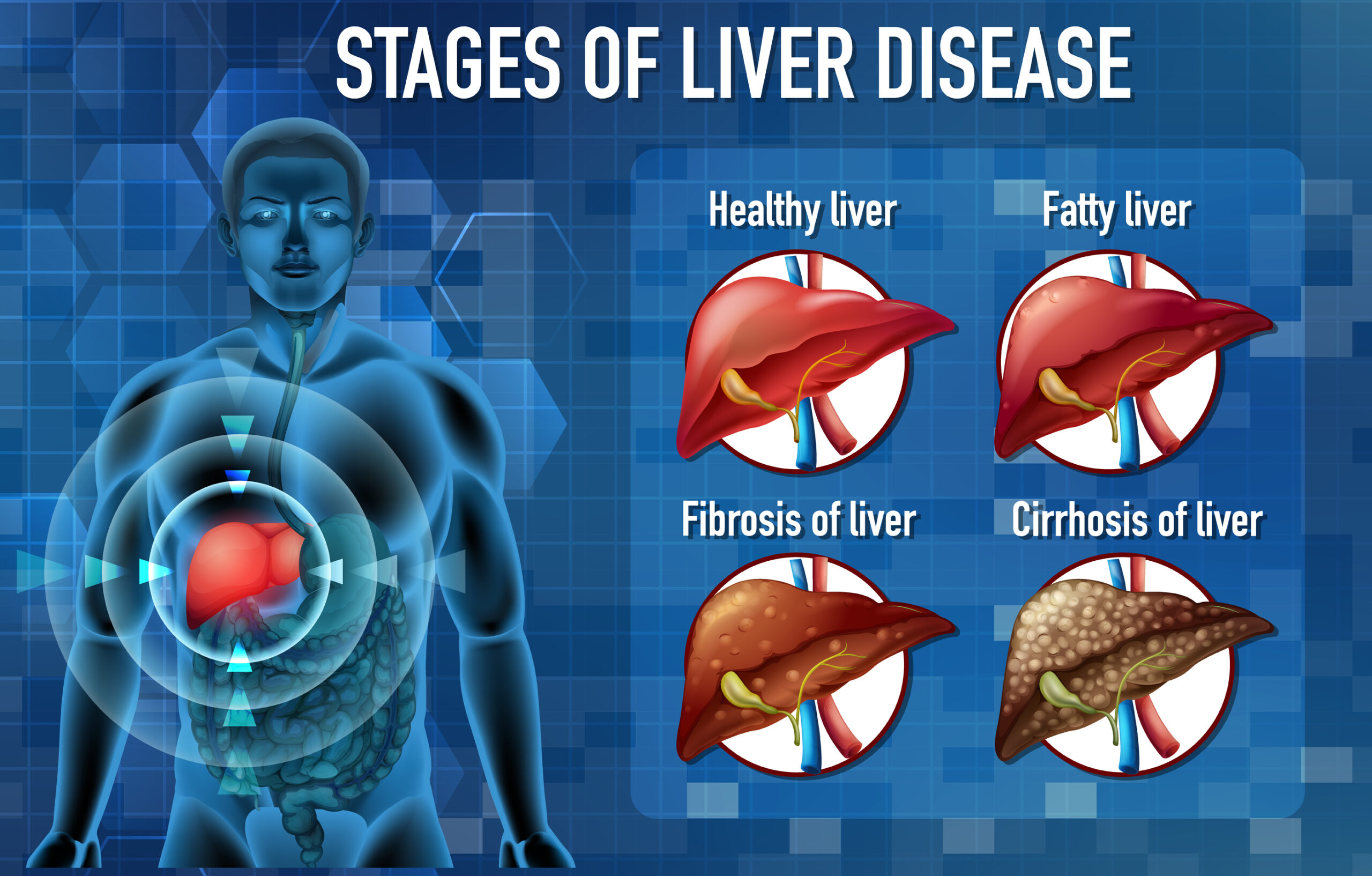 A list of 7 fatty liver symptoms